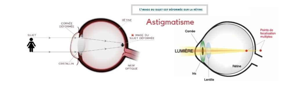 astigmatisme