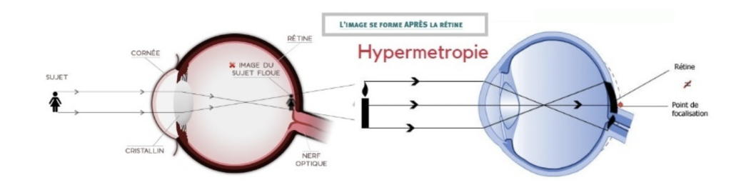 hypermétropie