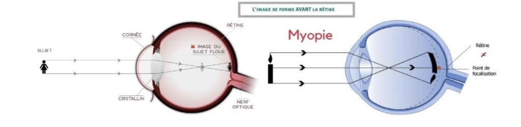 myopie